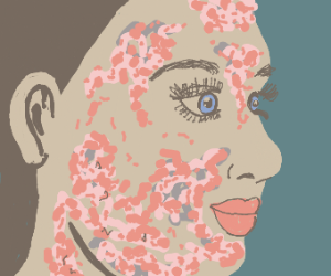 300x250 Acne Drawing - Acne Drawing