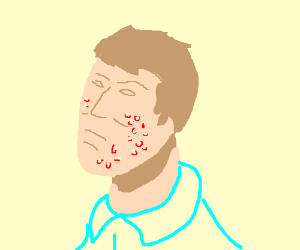300x250 Guy With Acne Drawing - Acne Drawing
