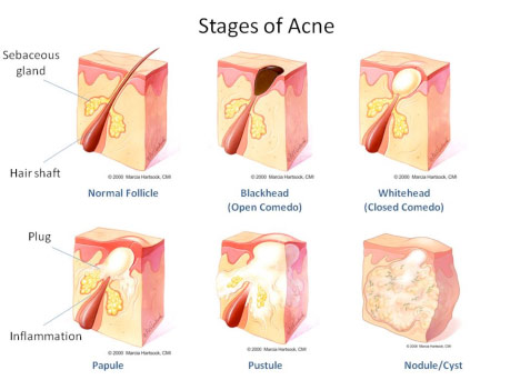 468x351 The Acne From A To Zit - Acne Drawing