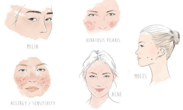 750x450 what are those tiny bumps on your face dermstore blog - Acne Drawin...