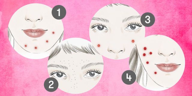 640x319 What Causes Acne - Acne Drawing