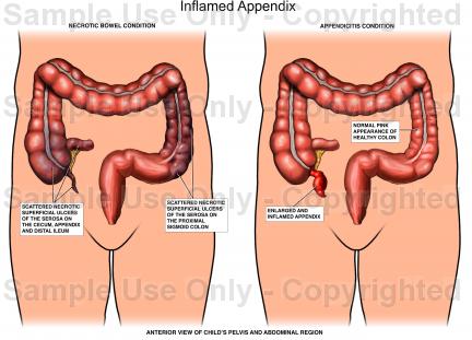 432x311 inflamed appendix - Appendix Drawing