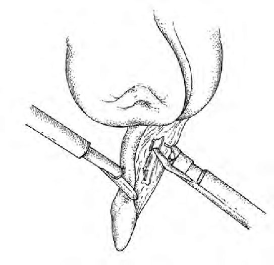 543x525 the appendix is freed - Appendix Drawing