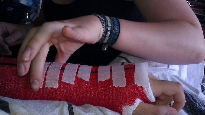 700x393 Cool Spiderman Cast Drawing Others - Arm Cast Drawing