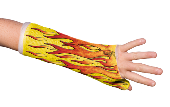 542x341  - Arm Cast Drawing