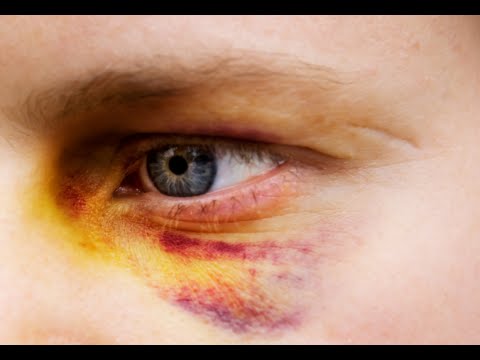480x360 How To Get Rid Of A Black Eye Fast - Black Eye Drawing