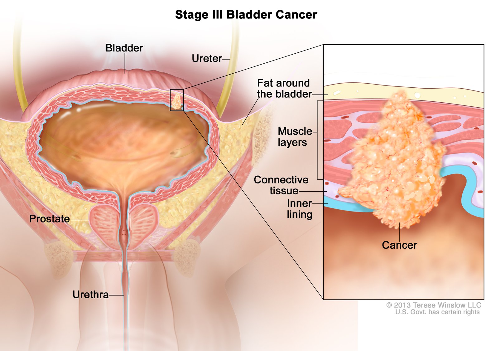 1575x1125 Fda Approves Nivolumab For Bladder Cancer - Bladder Drawing