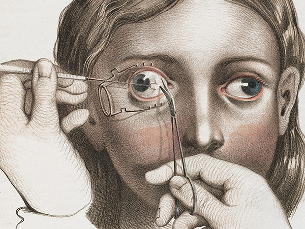 620x465 nuns with bleeding eyes! illustrations of c surgery - Bleeding Eye Drawing