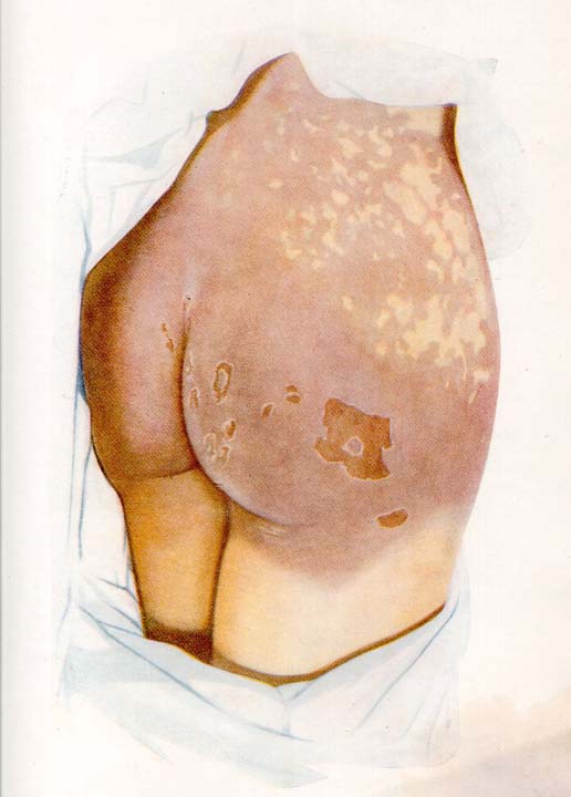 516x720 Blistering Of Buttocks - Blister Drawing