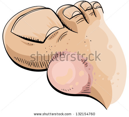 450x406 Collection Of Free Bister Clipart Toe Download On Ui Ex - Blister Drawing