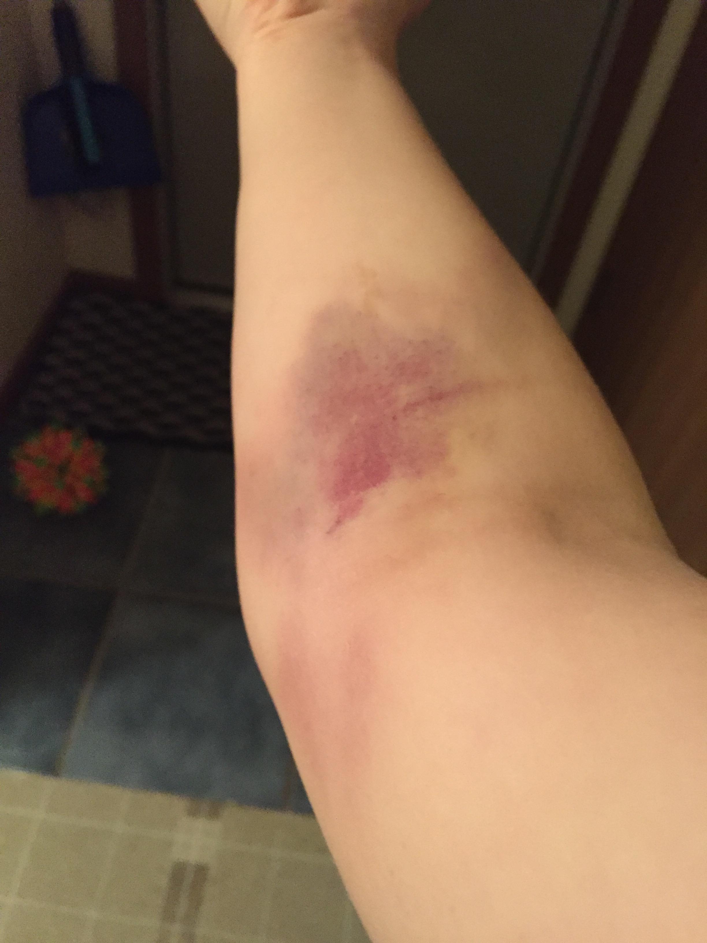2448x3264 blood drawing bruise - Blood Drawing