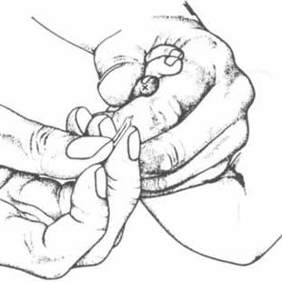 310x310 pdf recommendation for collection of venous blood from children - Blood Drawing Reference