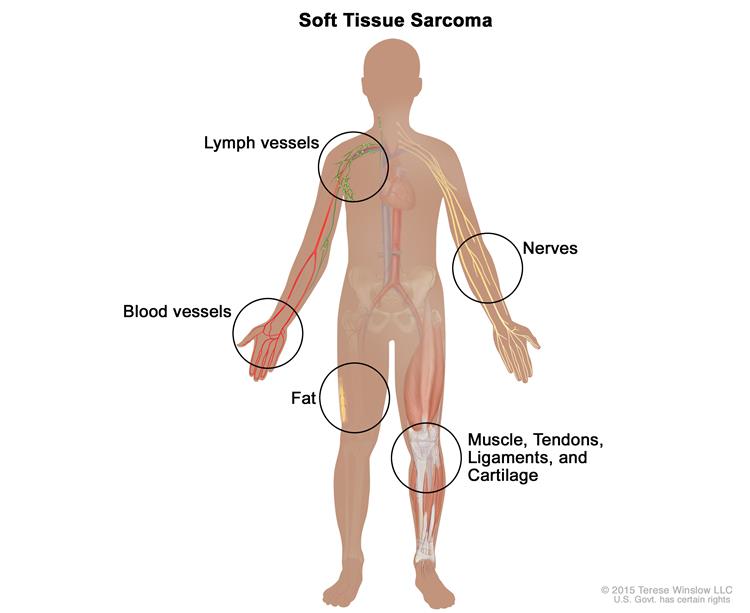 750x613 Definition Of Soft Tissue Sarcoma - Blood Tissue Drawing