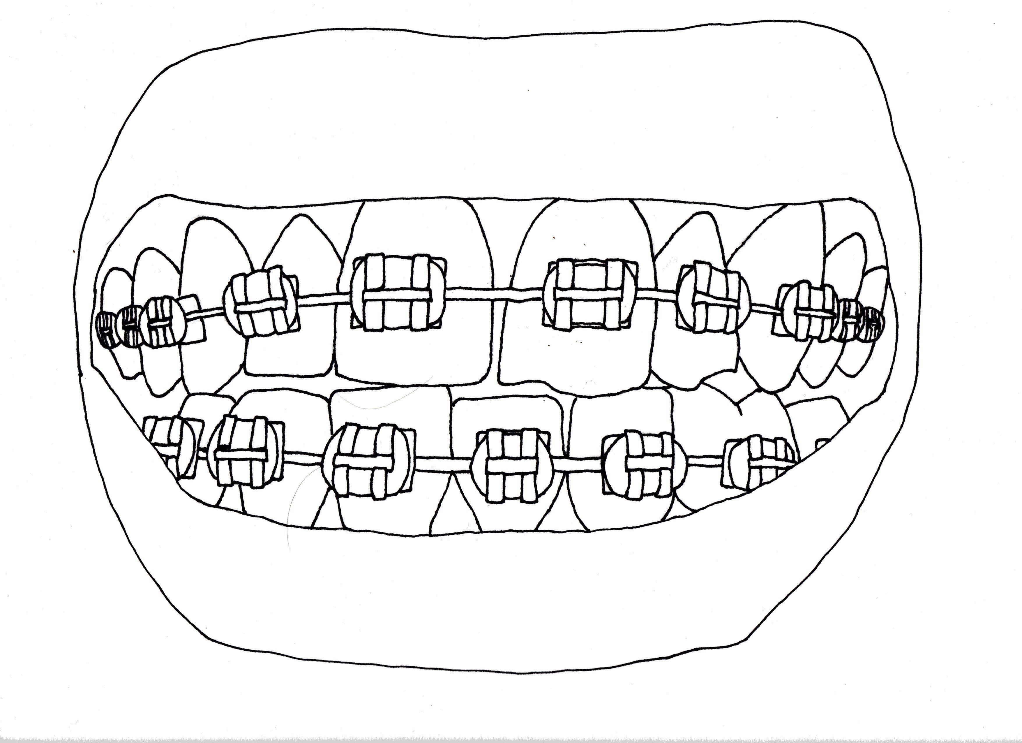 3509x2550 Braces Line Drawing - Braces Drawing
