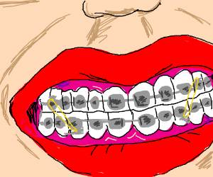 300x250 Braces Drawing - Braces Drawing