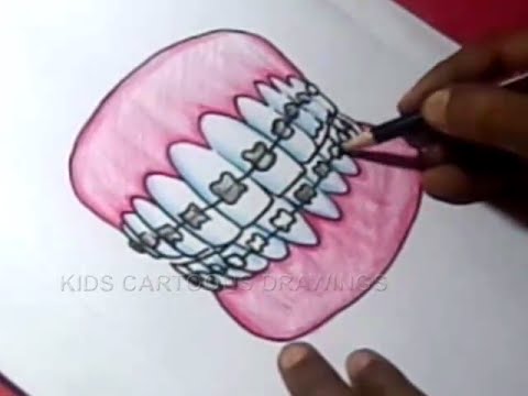 Braces Drawing at PaintingValley.com | Explore collection of Braces Drawing