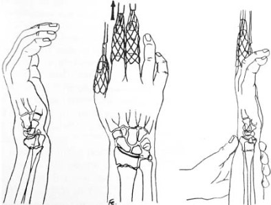 394x298 Broken Arm Update - Broken Arm Cast Drawing