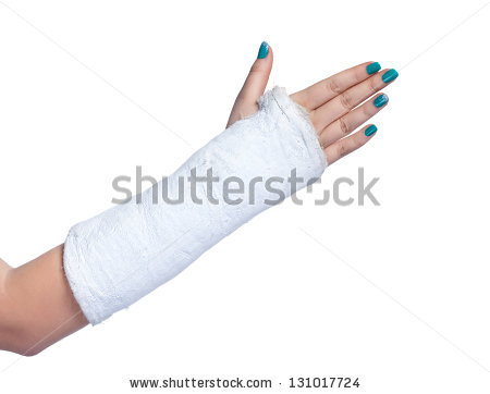 450x362 Collection Of Free Cast Drawing Decorated Download On Ui Ex - Broken Arm Cast Drawing