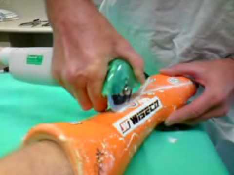 480x360 Removing My Arm Cast - Broken Arm Cast Drawing