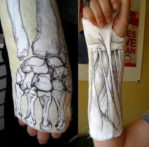 500x496 arm and leg cast artwork illustrations arm cast, cast art - Broken Arm...