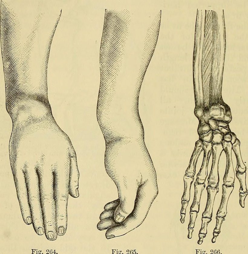 820x840 Broken Bones News, Sports, Jobs - Broken Bone Drawing