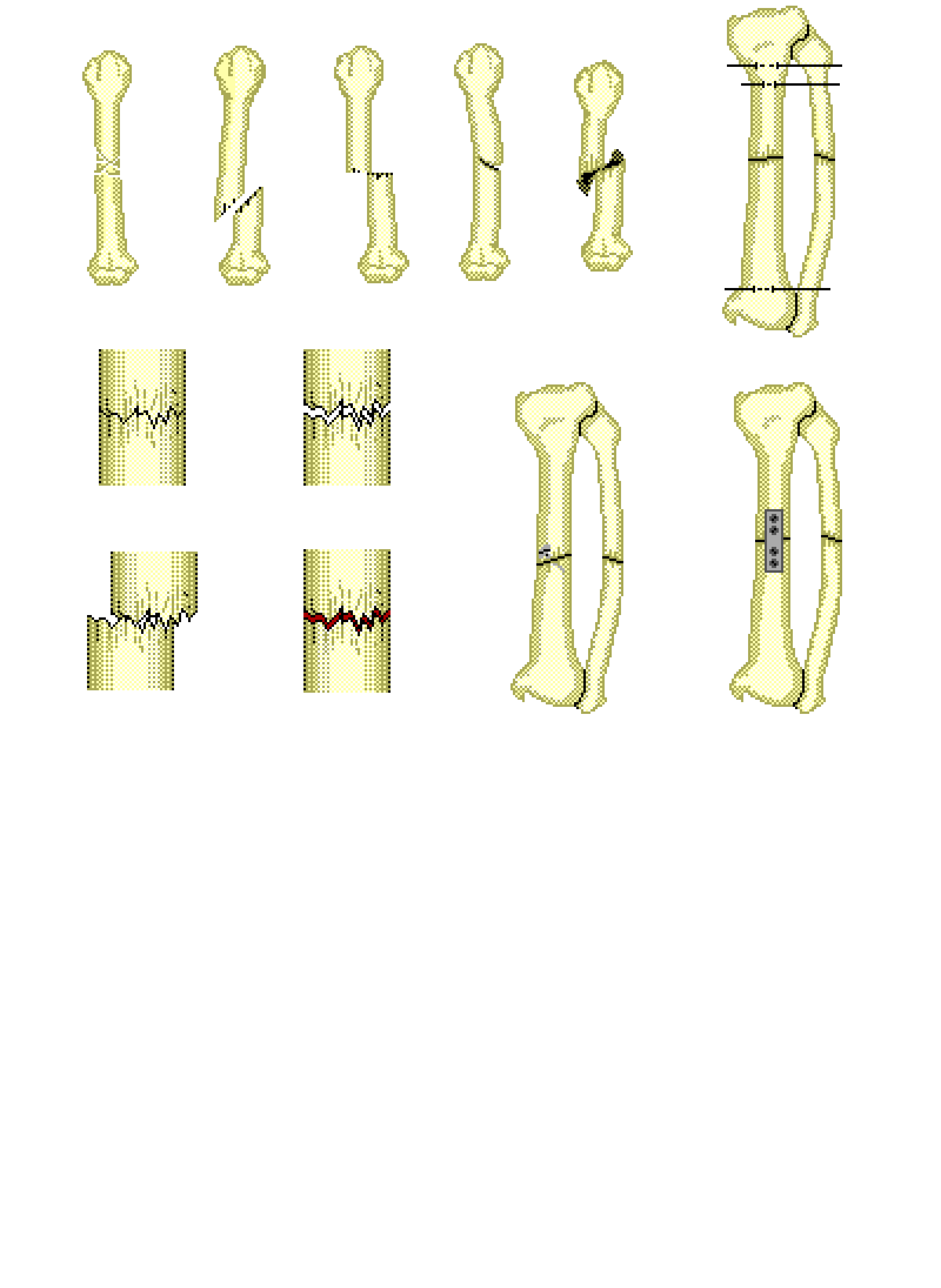 Рисунок перелома кости. Переломы диафиза бедренной кости классификация. Перелом малоберцовой кости классификация. Переломы лучевой кости классификация.