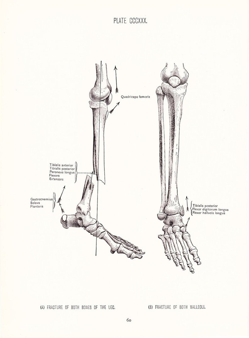 Broken Bone Drawing at PaintingValley.com | Explore collection of ...