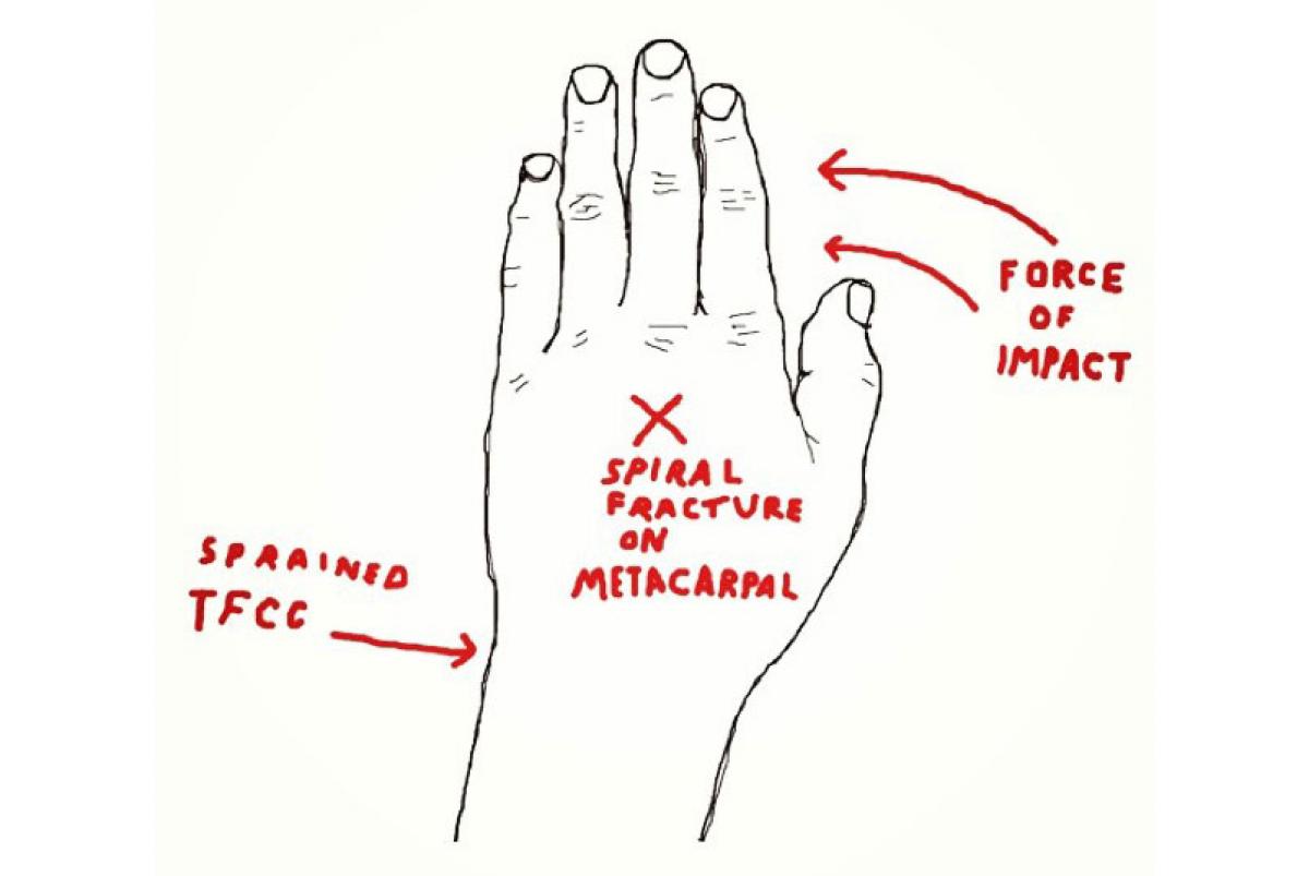 1200x803 Stab Magazine A Broken Hand Won't Keep Dane Reynolds Out Of Lowers - Broken Hand Drawing