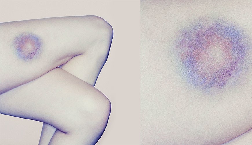 870x500 Bruise Easily Facts You Need To Know Self - Bruise Drawing