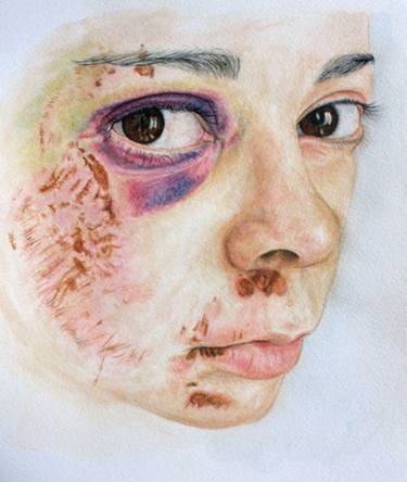 375x444 Bruised Ii Painting - Bruise Drawing