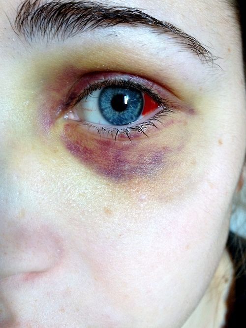 500x667 Treating A Black Eye Bruise Astar Beauty - Bruise Drawing