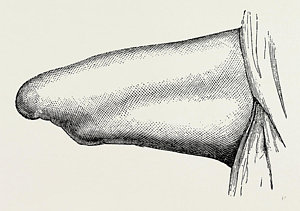 300x211 conical stump following circular, medical equipment drawing - Circular Drawings