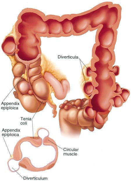 450x621 diverticulosis drawing shows colonic diverticulosis and circular - Colon Drawing