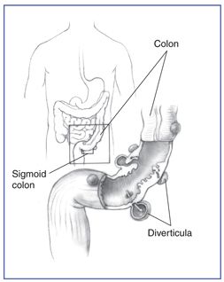 253x318 drawing of the colon and an enlargement of it showing diverticula - Colon Drawing