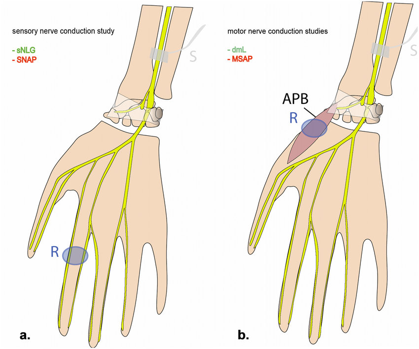 850x709 schematic drawing of median nerve conduction measurements sensory - Conduction Drawing