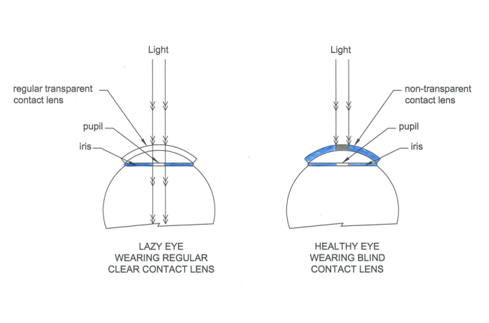 700x463 blind contact lens - Contact Lens Drawing