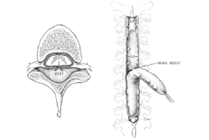 720x482 a drawing of a spinal cross section showing a dural defect - Cyst Drawing