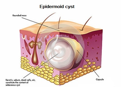 420x303 alltop rss feed for alternative - Cyst Drawing