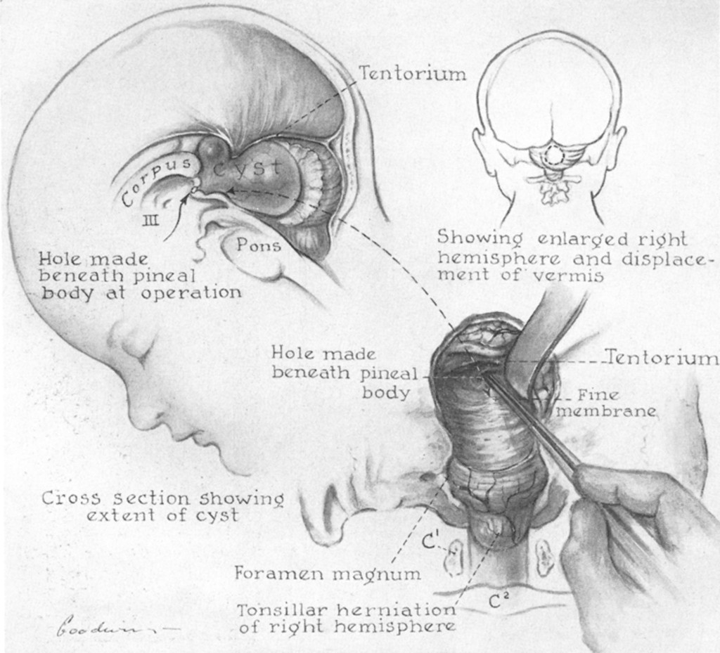 1024x929 benign subtentorial supracollicular cyst as a cause of obstructive - Cyst Drawing