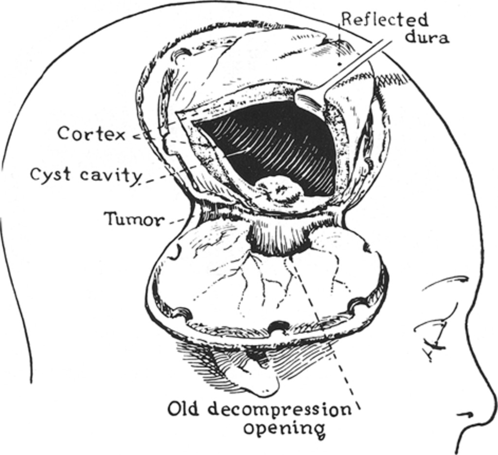 1024x935 cystic pilocytic astrocytomas of the cerebral hemispheres - Cyst Drawing