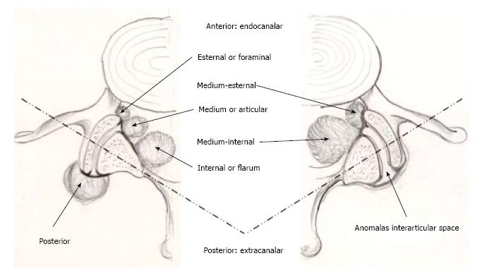 690x390 lumbar ganglion cyst nosology, surgical management and proposal - Cyst Drawing