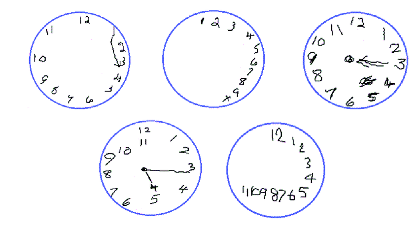 850x469 Examples Of Clock Drawings Produced - Dementia Clock Drawing