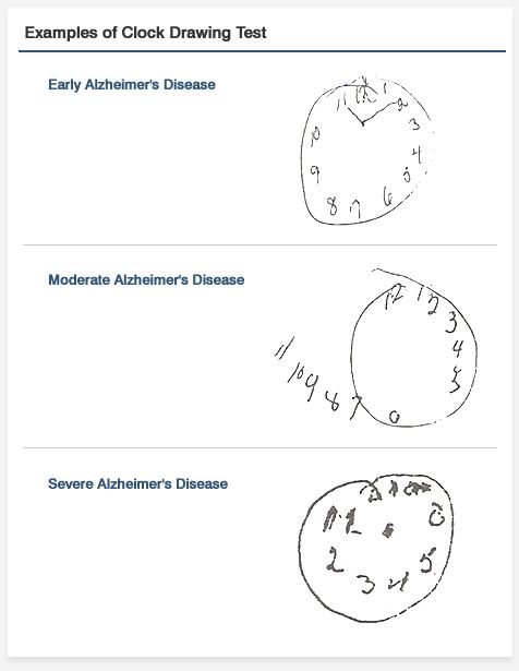 476x615 the infamous clock test alzheimer's clock drawings, mental - Dementia Clock Drawing