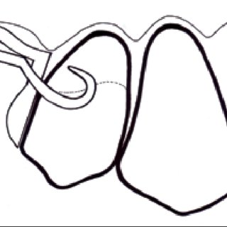 320x320 pdf aesthetic clasp design for removable partial dentures - Dentures Drawing