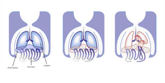 640x323 malformations of the diaphragm and abdominal wall - Diaphragm Drawing