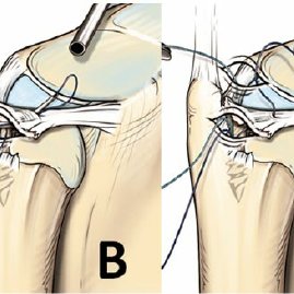 269x269 c drawing to show the arthroscopic procedure to repair the tfcc - Drawing Repair