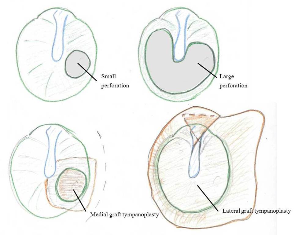 975x769 middle ear surgery - Eardrum Drawing