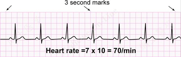 601x191 Ecg A Pictorial Primer - Ecg Drawing