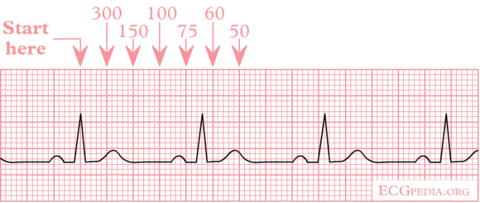 700x297 Interpret Ekgs Strips Like A Boss! - Ecg Drawing