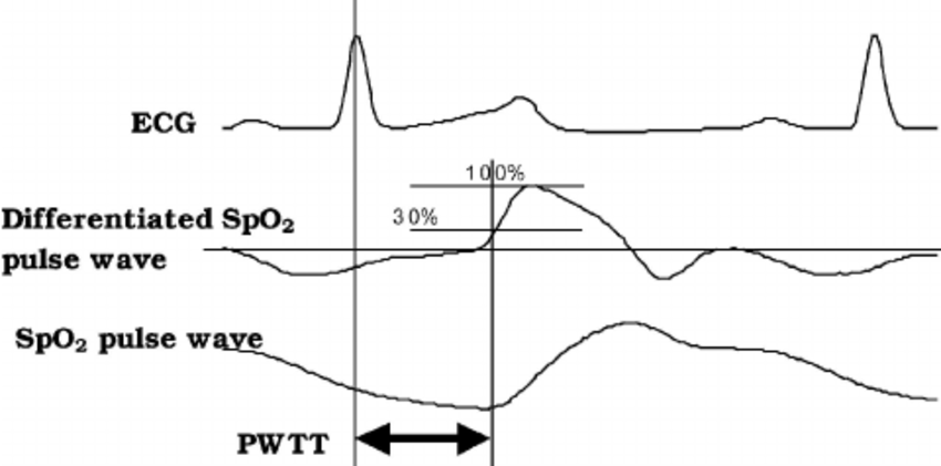 850x421 The Representative Drawing Of Electrocardiogram - Ecg Drawing